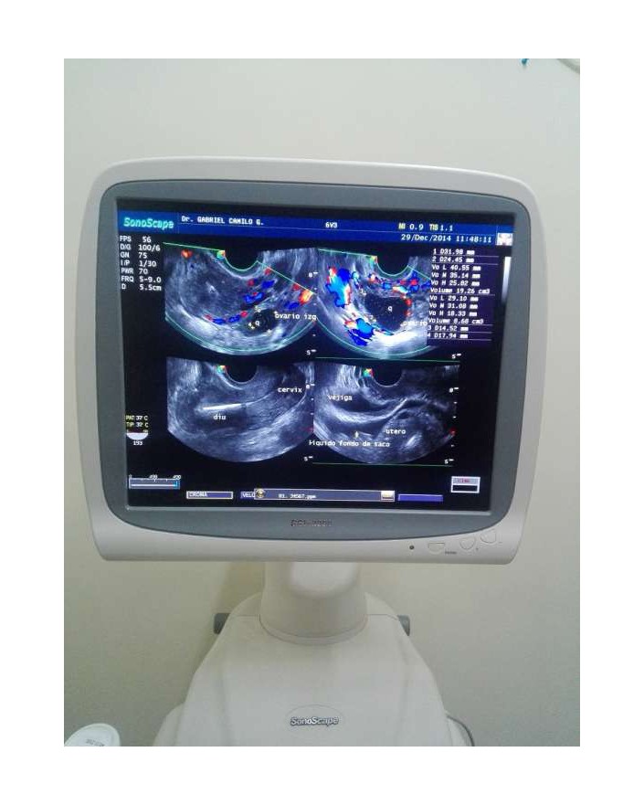 Sonoscape SSI-8000 Ultrasound Machine Ultrasound